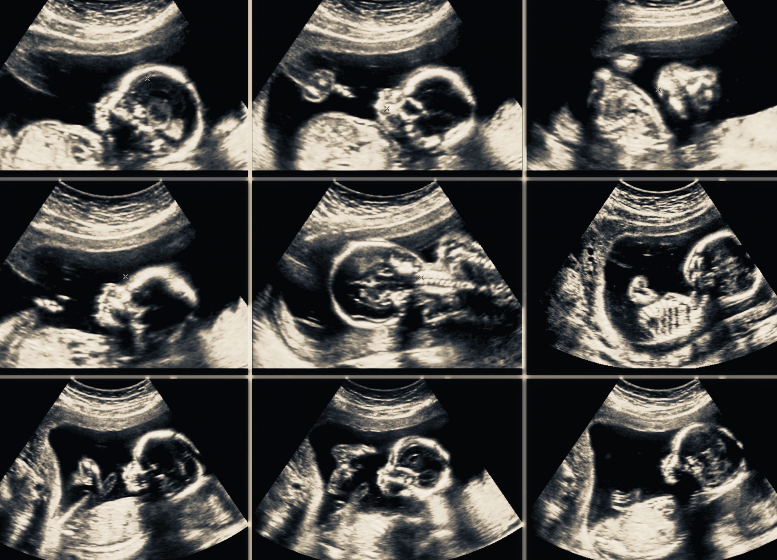 Abdômen Total ou Abdômen Superior – IMMEF - Instituto da Mulher e de  Medicina Fetal em Curitiba
